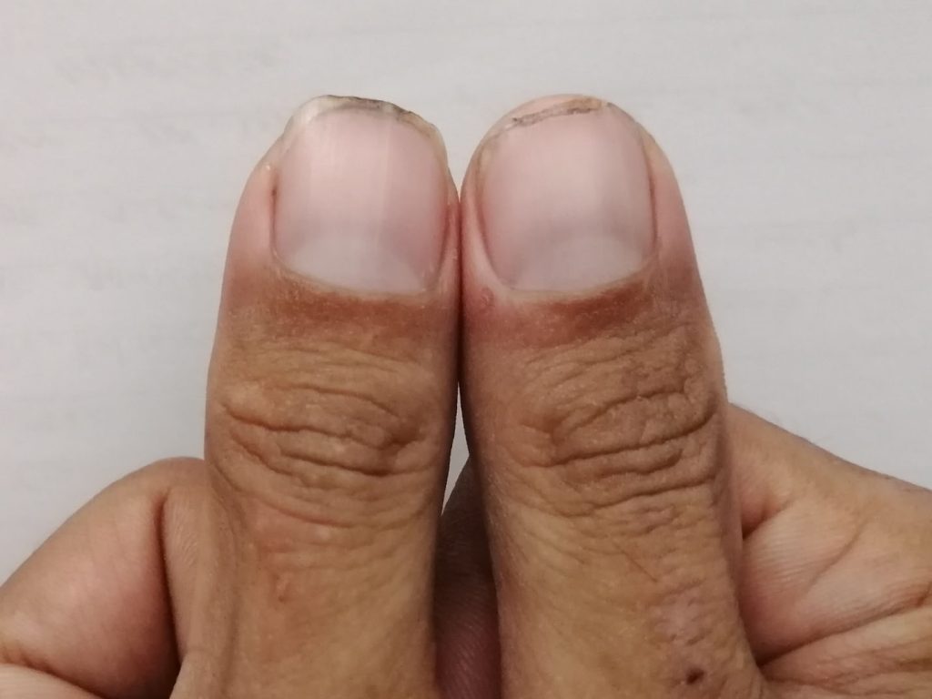 Injured thumb from picking chilies.