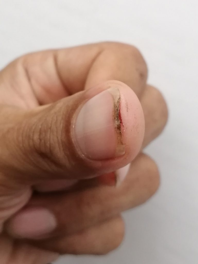 Injured thumb from picking chilies.